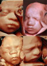 Private 4D Scans at MUMS Solihull with our Fetal Medicine Consultants – Anoop, and Davide