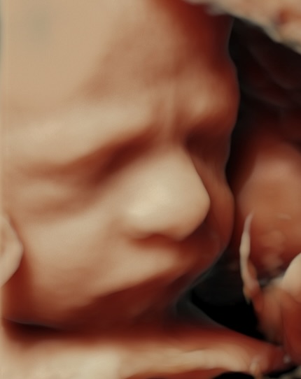 4D Ultrasound Scans at MUMS
